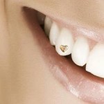 bijuterii dentare