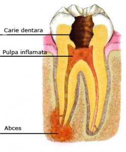 endodontic-patologie