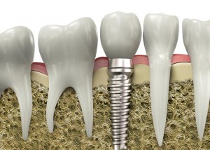 implant dentar 4