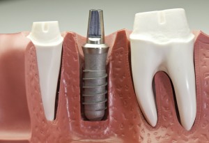 implant dentar